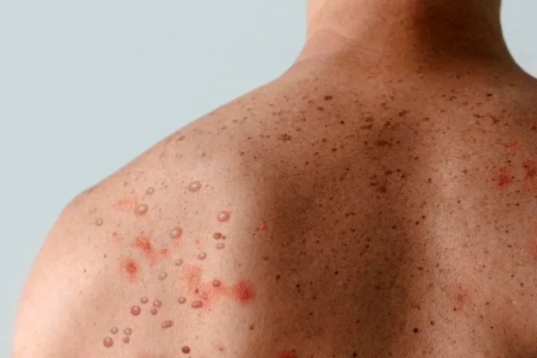 Bahia Registra Dois Casos de Mpox e Combate Fake News sobre a Doença